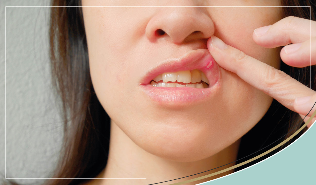 Mouth ulcers causes & prevention