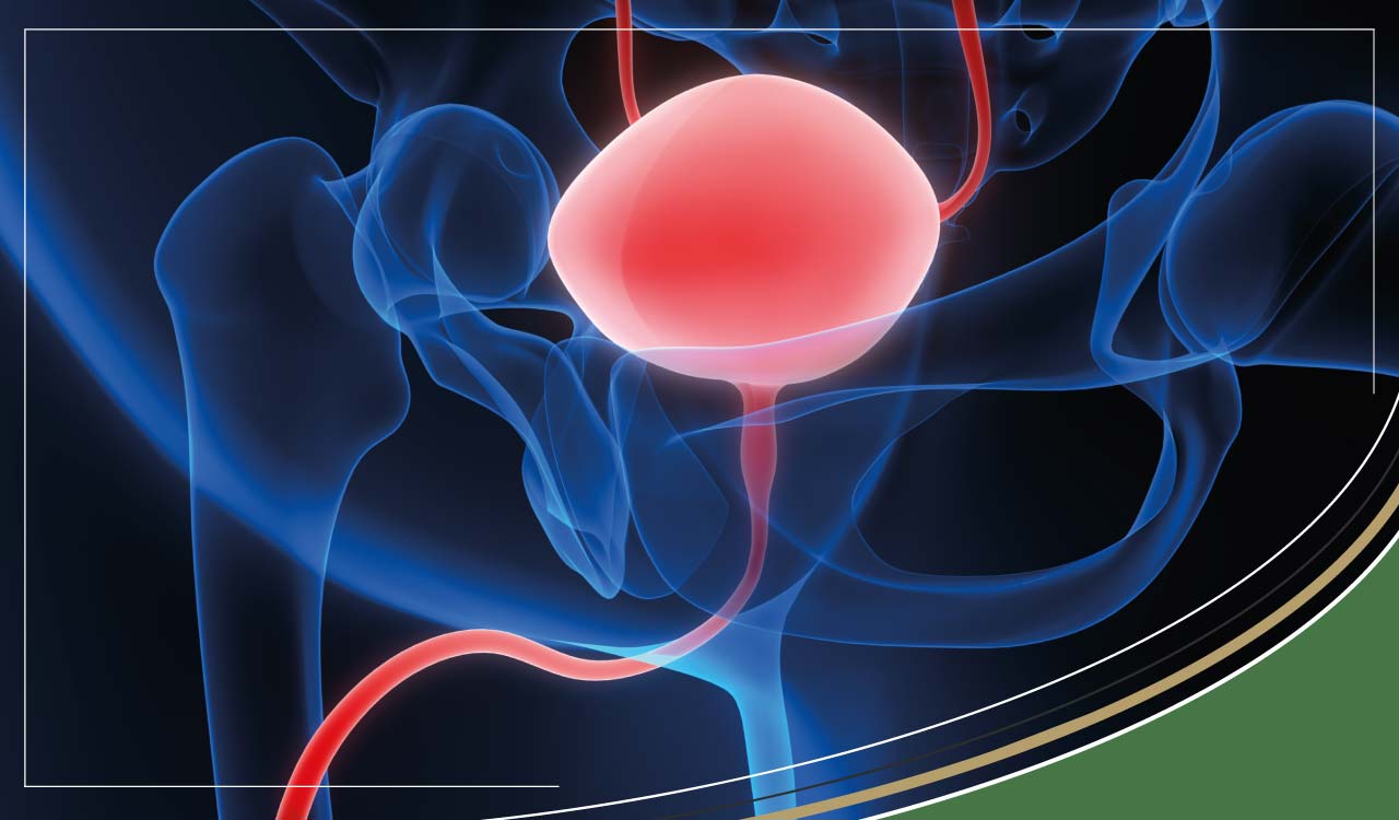 Radiation cystitis symptoms and prevention